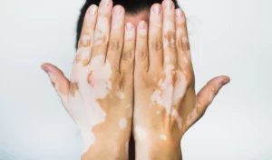Everything-you-need-to-know-about-vitiligo-treatment-options_mobilehome-300x176